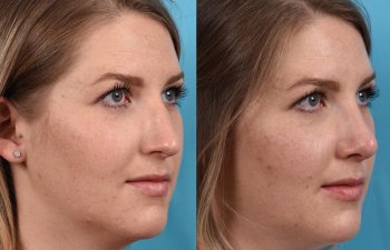 Female patient before and after rhinoplasty - right side.