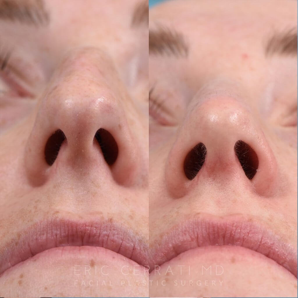 female patient before and after rhinoplasty - front