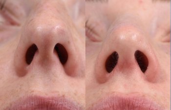 female patient before and after rhinoplasty - front