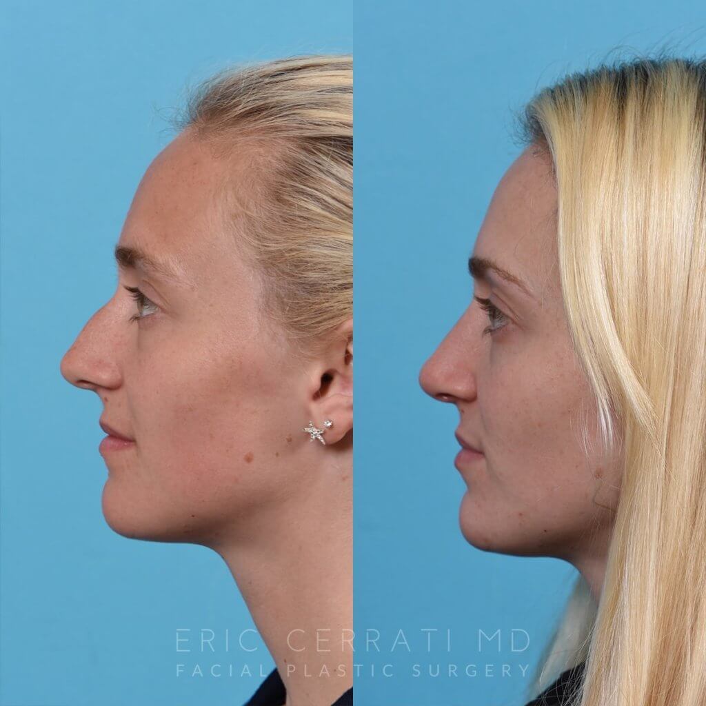 Female patient before and after rhinoplasty -left side