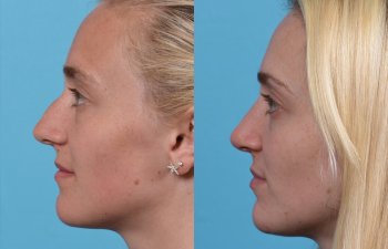 Female patient before and after rhinoplasty -left side
