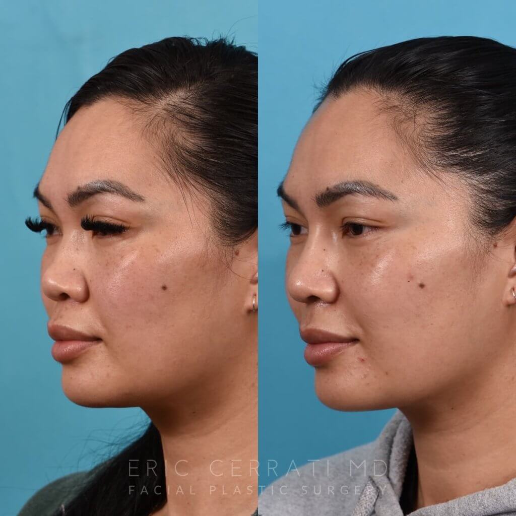 Female patient before and after rhinoplasty - left side