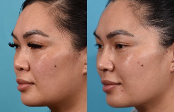 Female patient before and after rhinoplasty - left side