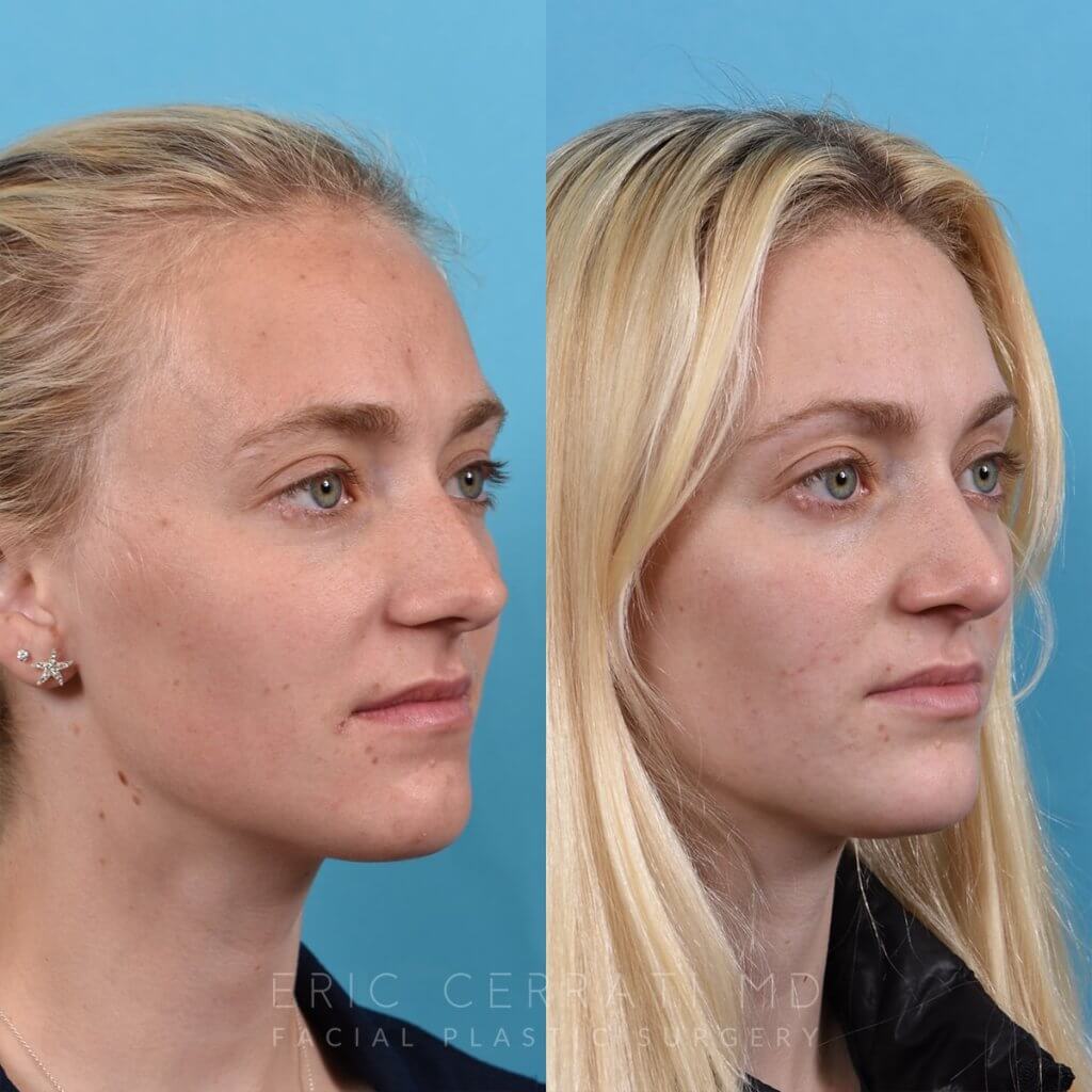 Female patient before and after rhinoplasty -right side