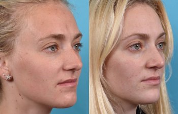Female patient before and after rhinoplasty -right side