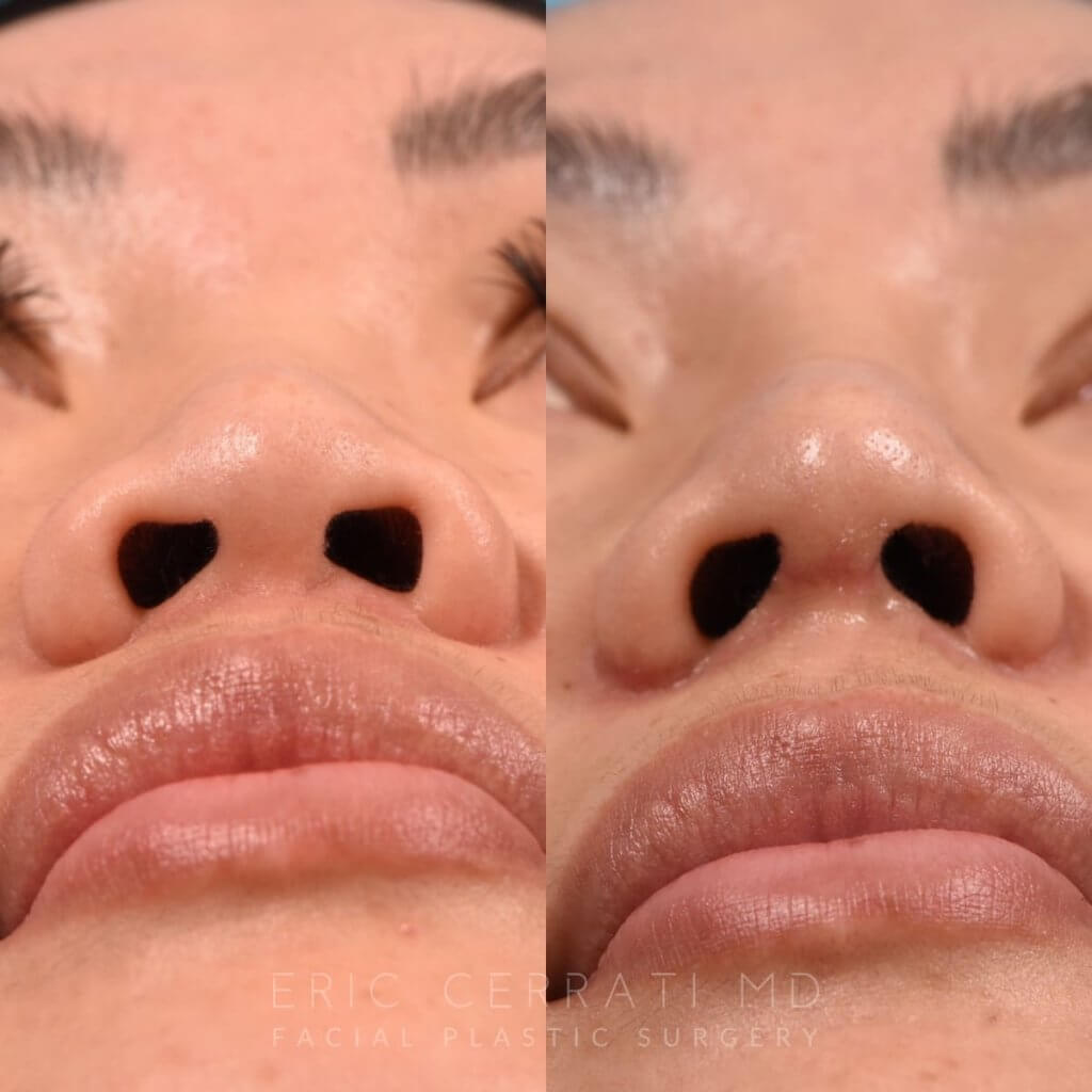 Female patient before and after rhinoplasty - base