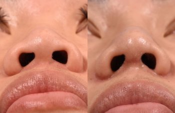 Female patient before and after rhinoplasty - base