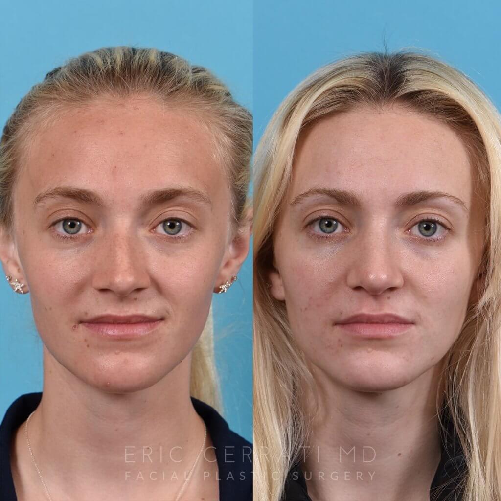 Female patient before and after rhinoplasty -front