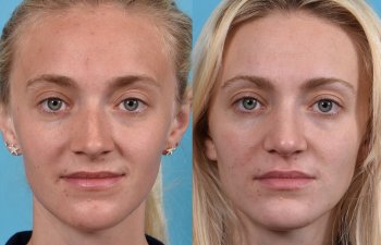 Female patient before and after rhinoplasty -front