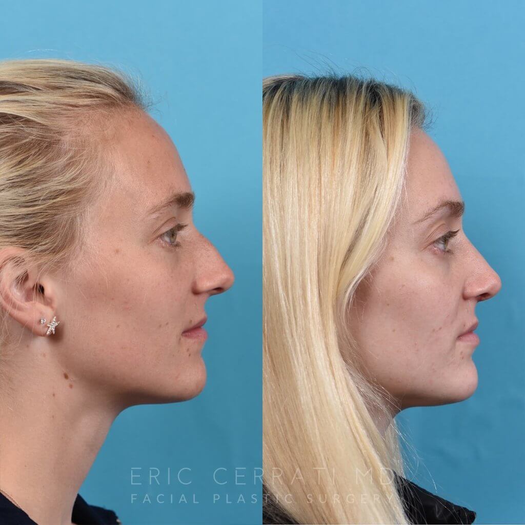 Female patient before and after rhinoplasty -right side