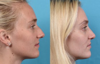 Female patient before and after rhinoplasty -right side