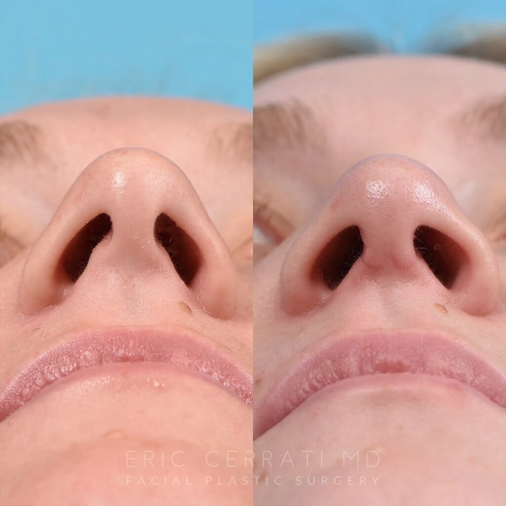 Female patient before and after rhinoplasty -front