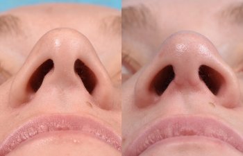 Female patient before and after rhinoplasty -front
