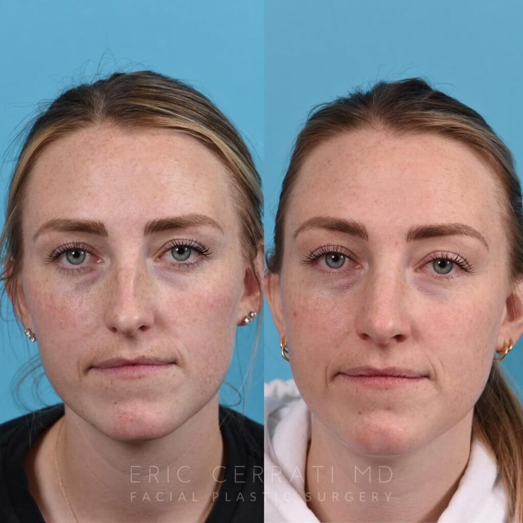 Female patient before and after rhinoplasty - front