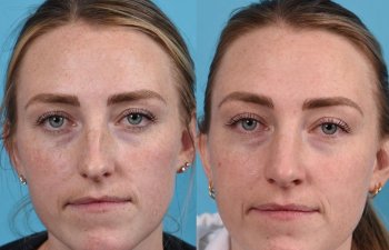 Female patient before and after rhinoplasty - front