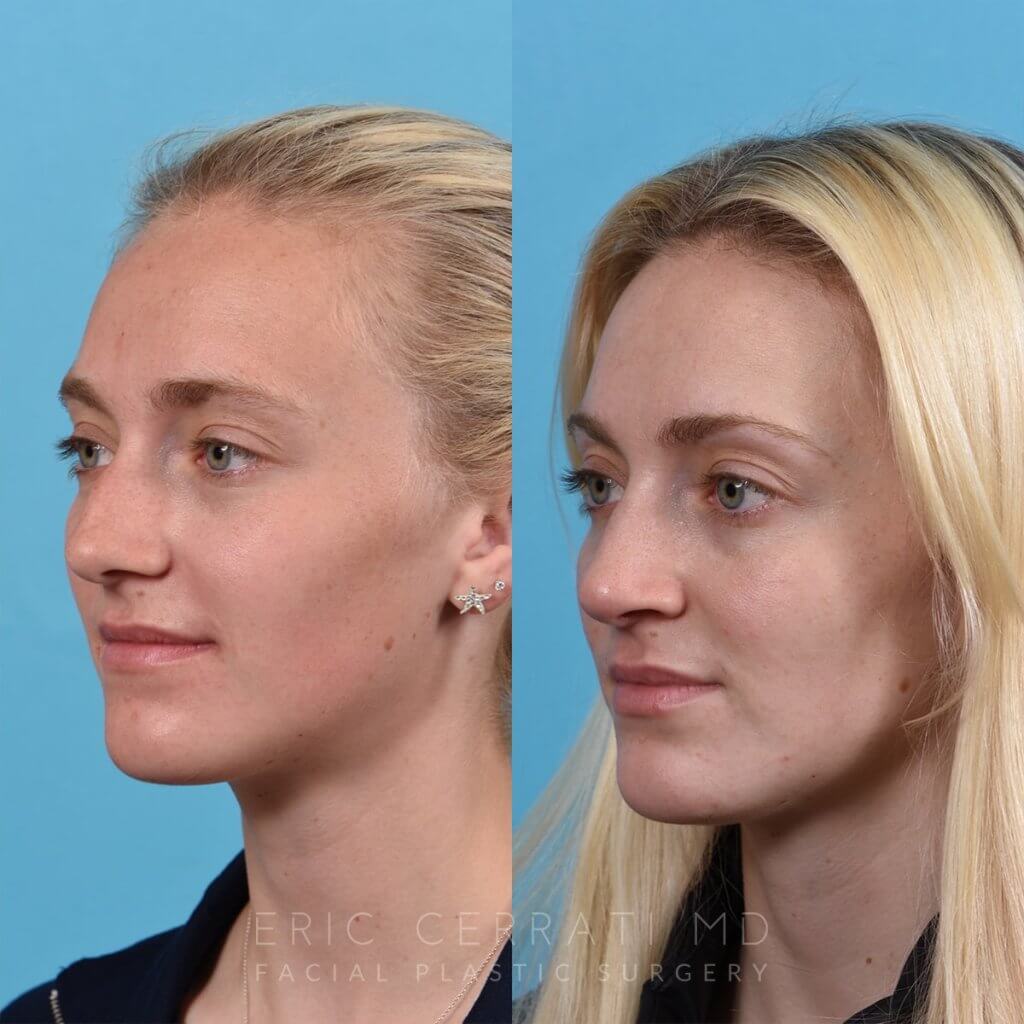 Female patient before and after rhinoplasty -left side