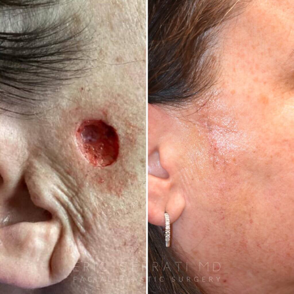 Before and after reconstructive surgery.