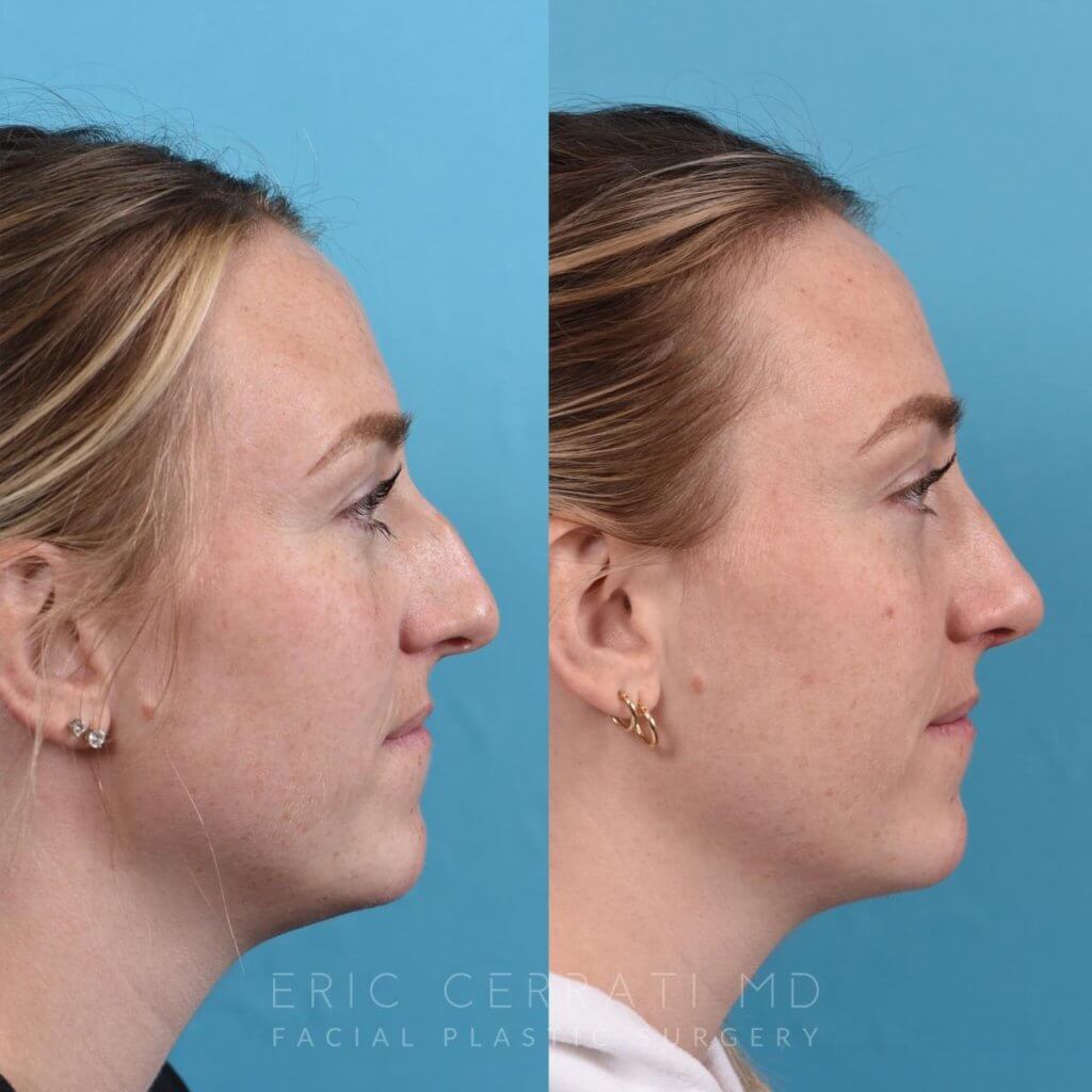 Female patient before and after rhinoplasty - right side.