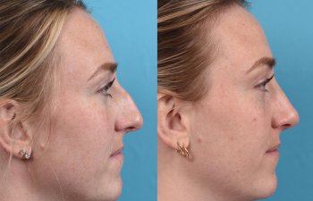 Female patient before and after rhinoplasty - right side.