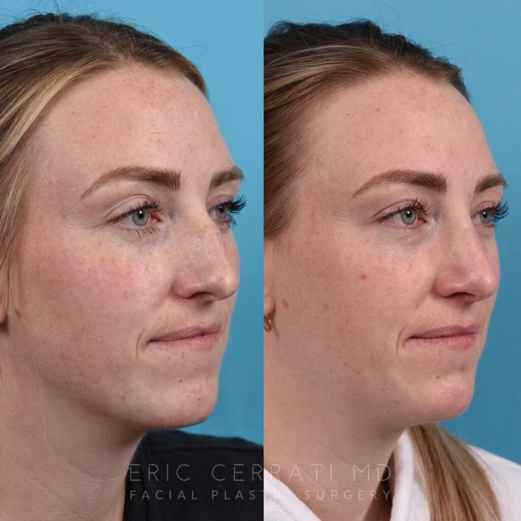 Female patient before and after rhinoplasty - right side.