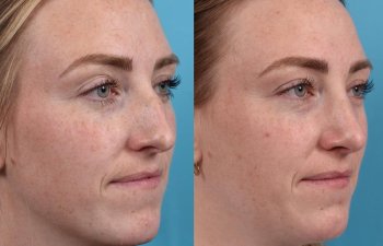 Female patient before and after rhinoplasty - right side.