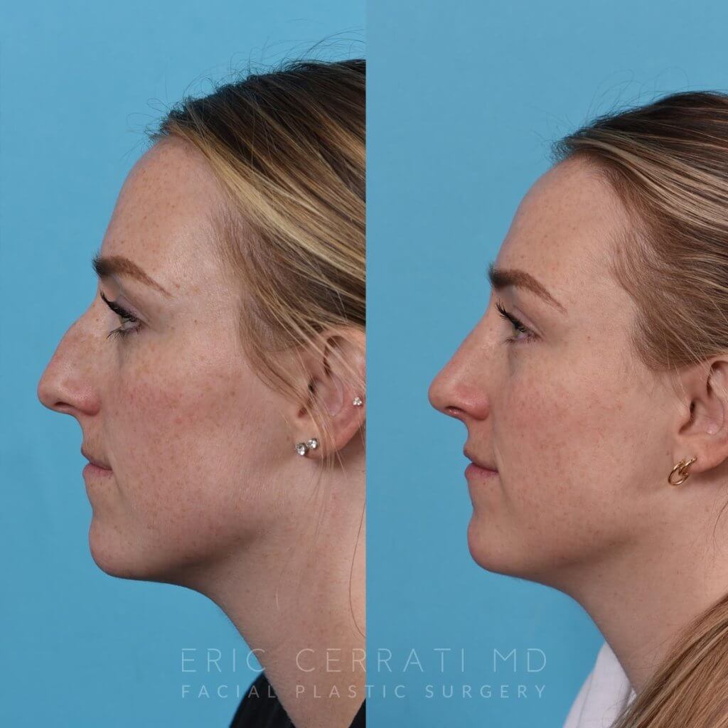 Female patient before and after rhinoplasty - left side.