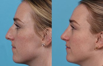 Female patient before and after rhinoplasty - left side.