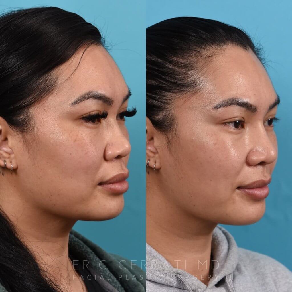 Female patient before and after rhinoplasty - right side
