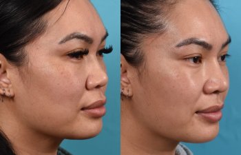 Female patient before and after rhinoplasty - right side