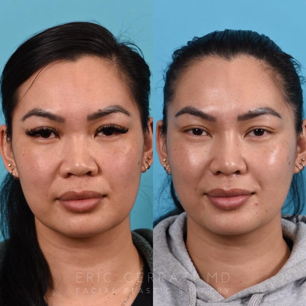 Female patient before and after rhinoplasty - front