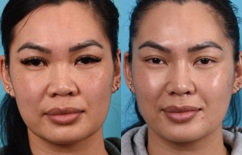 Female patient before and after rhinoplasty - front