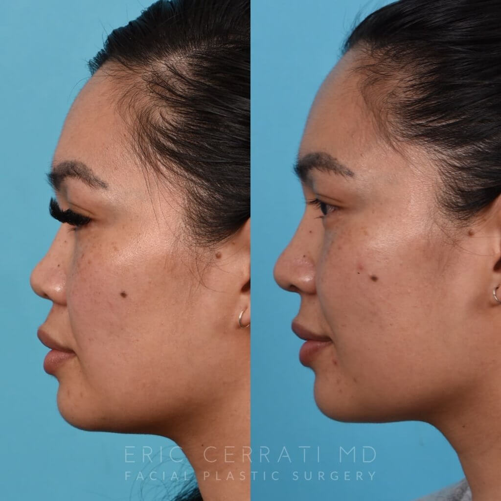 Female patient before and after rhinoplasty - left side