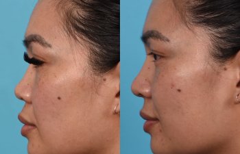 Female patient before and after rhinoplasty - left side