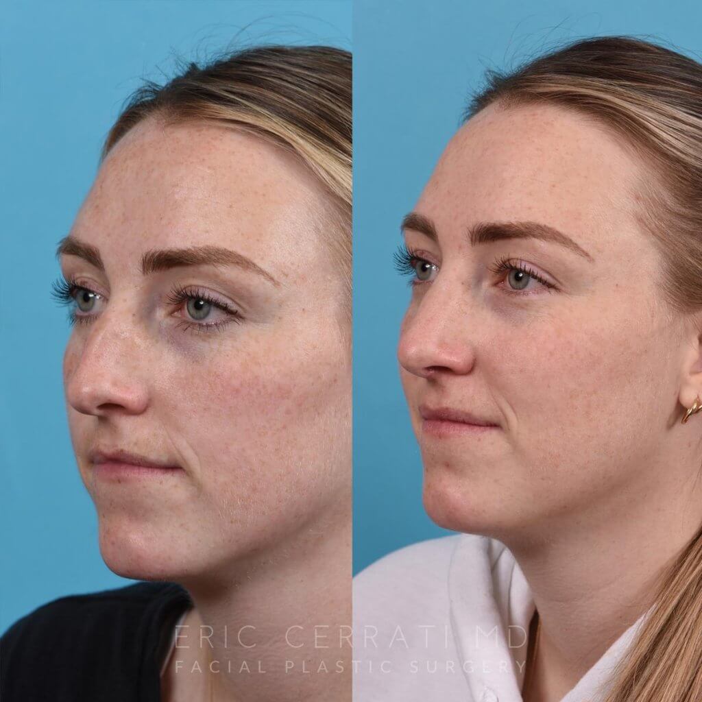 Female patient before and after rhinoplasty - left side.