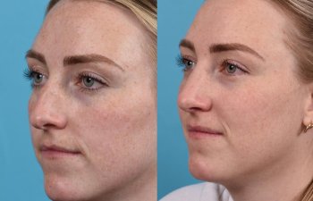 Female patient before and after rhinoplasty - left side.