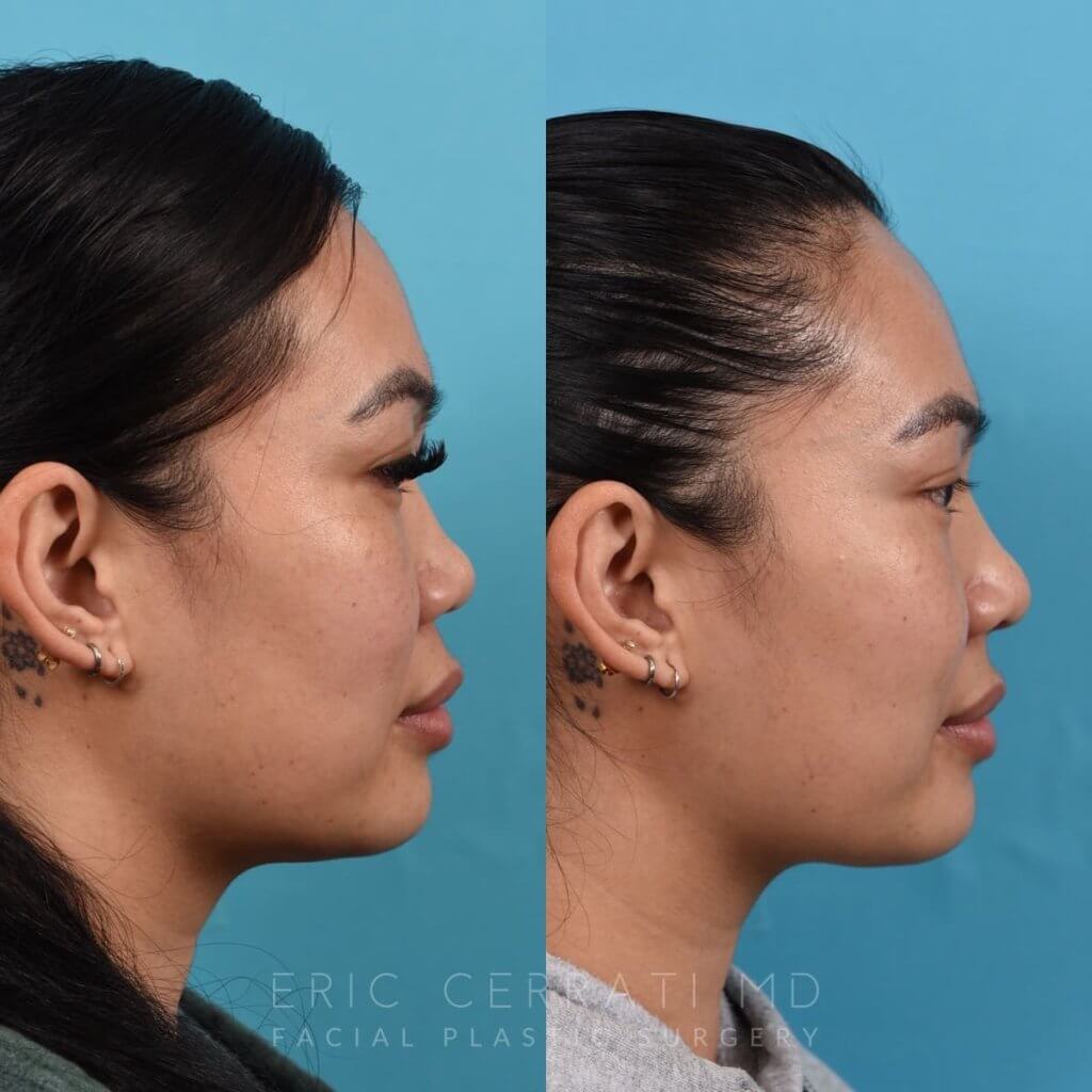 Female patient before and after rhinoplasty - right side