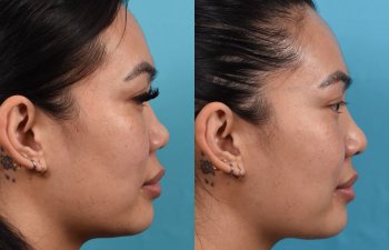 Female patient before and after rhinoplasty - right side