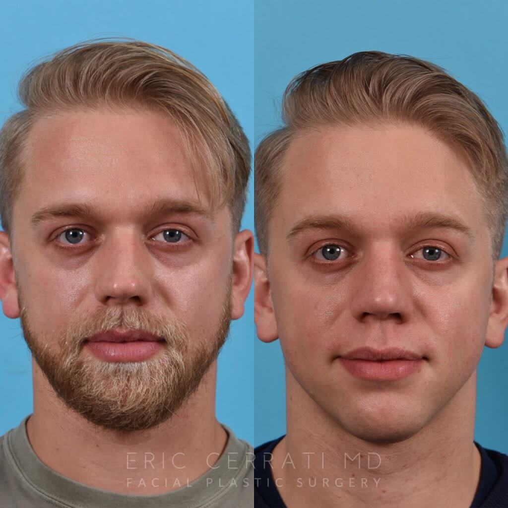 Male patient before and after rhinoplasty - front
