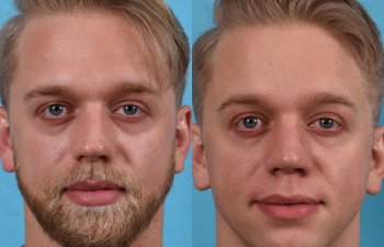Male patient before and after rhinoplasty - front