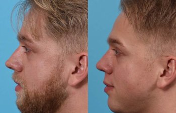 Male patient before and after rhinoplasty - left side
