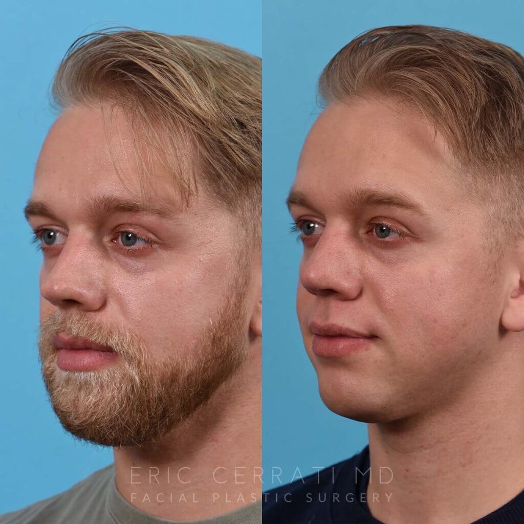Male patient before and after rhinoplasty - left side