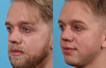 Male patient before and after rhinoplasty - left side
