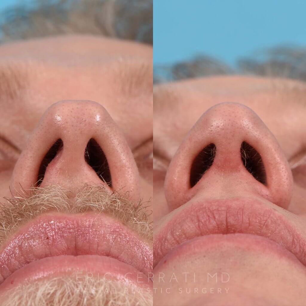 Male patient before and after rhinoplasty - base