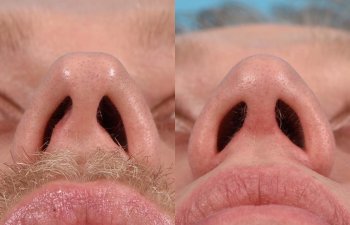 Male patient before and after rhinoplasty - base