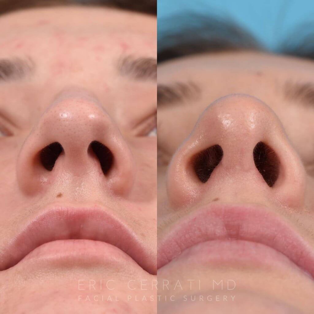 Female patient before and after rhinoplasty - right side