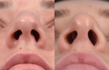 Female patient before and after rhinoplasty - right side