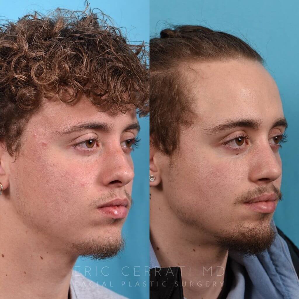 Male patient before and after rhinoplasty - right side