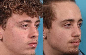 Male patient before and after rhinoplasty - right side