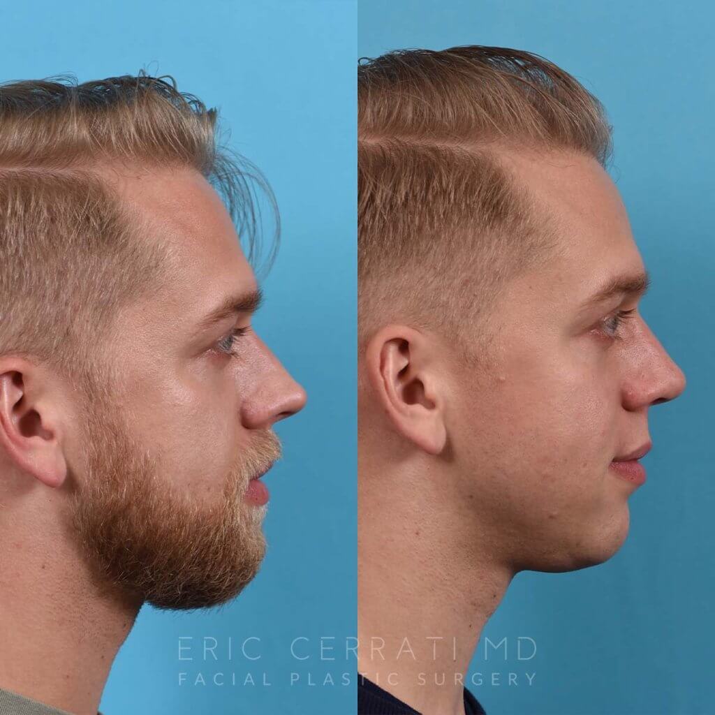 Male patient before and after rhinoplasty - right side
