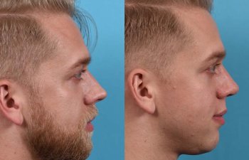 Male patient before and after rhinoplasty - right side